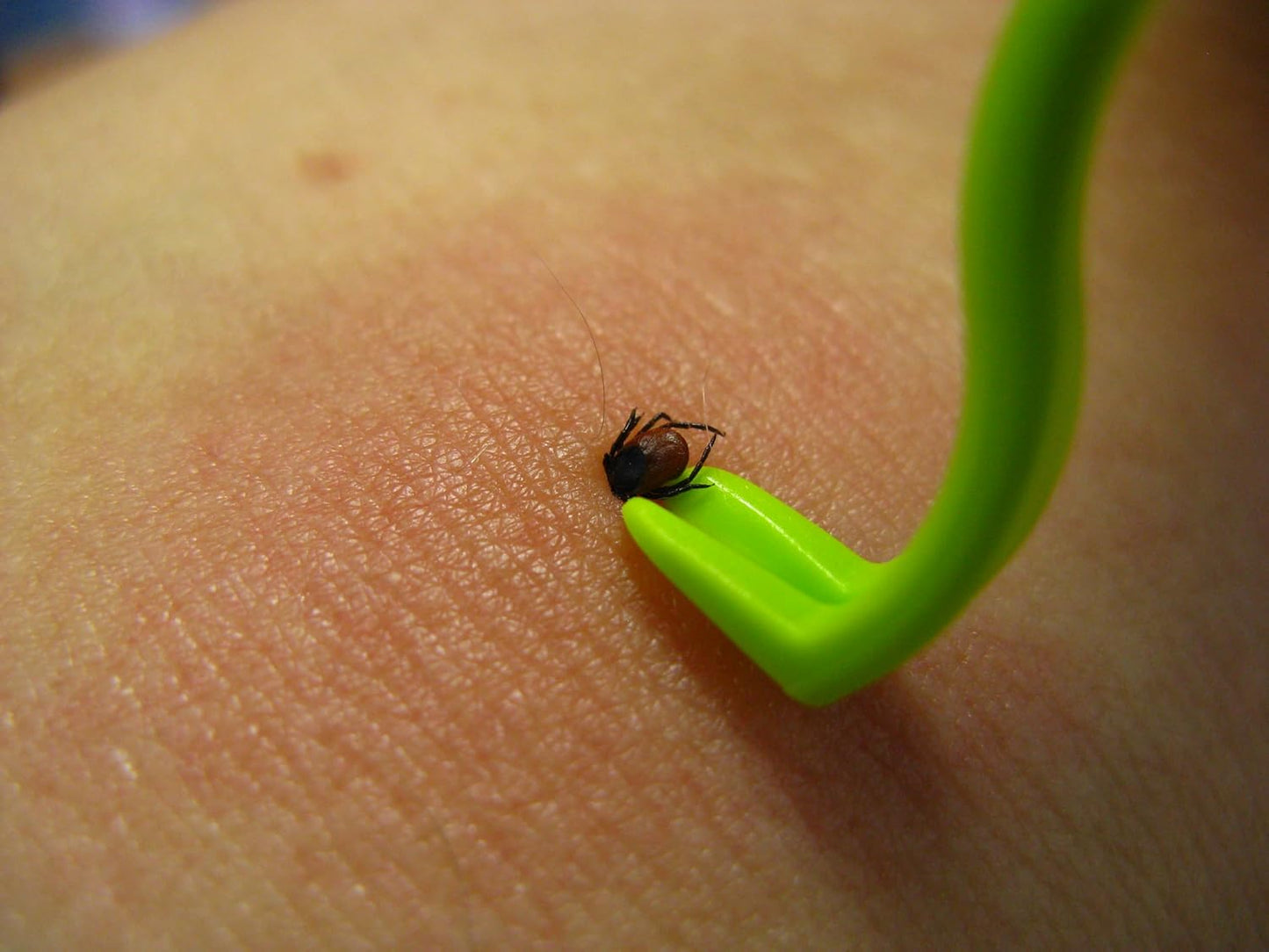 Tick Remover Set of 3